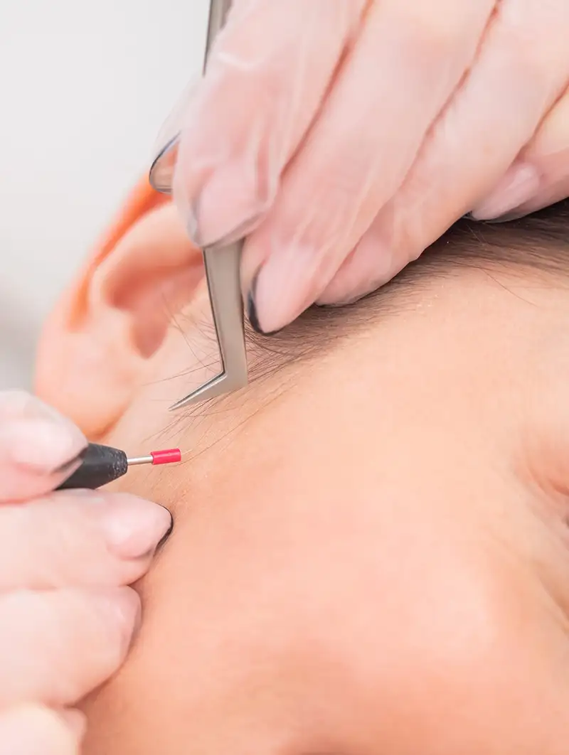 Blemish removal