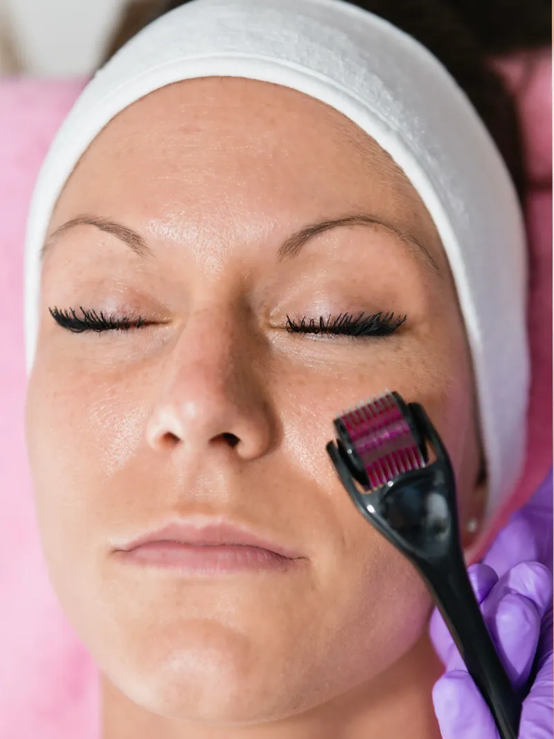 Microneedling