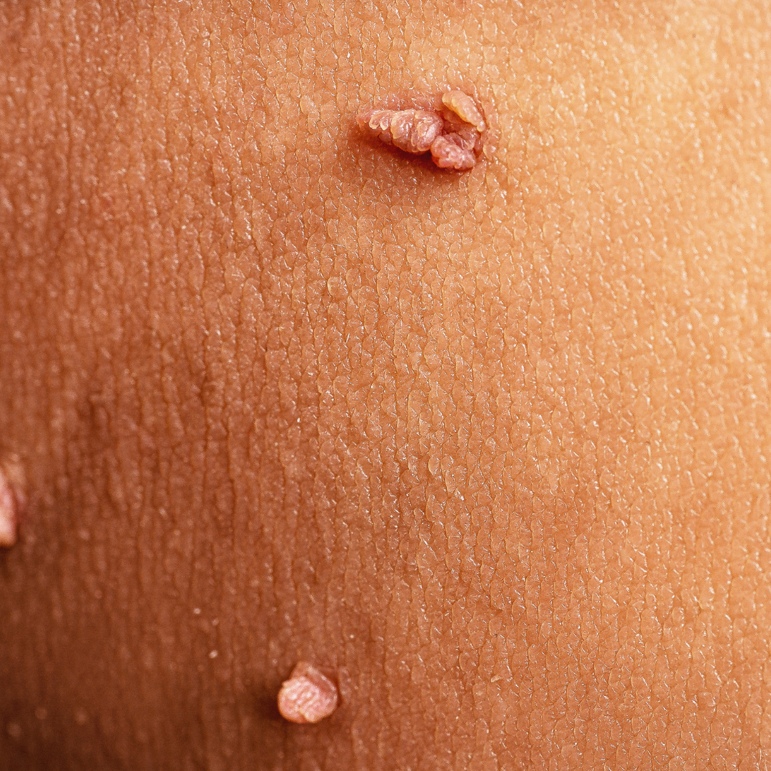 Skin Tags